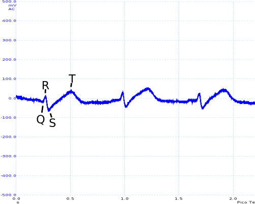 Annotated vest ECG trace